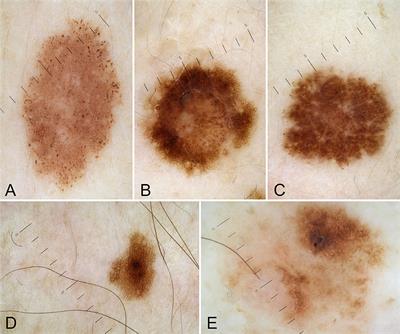 Dermatological and Dermoscopic Baselines in BRCA Mutation Carriers